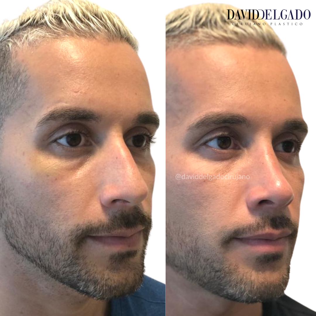 Before and after rhinoplasty in Colombia"