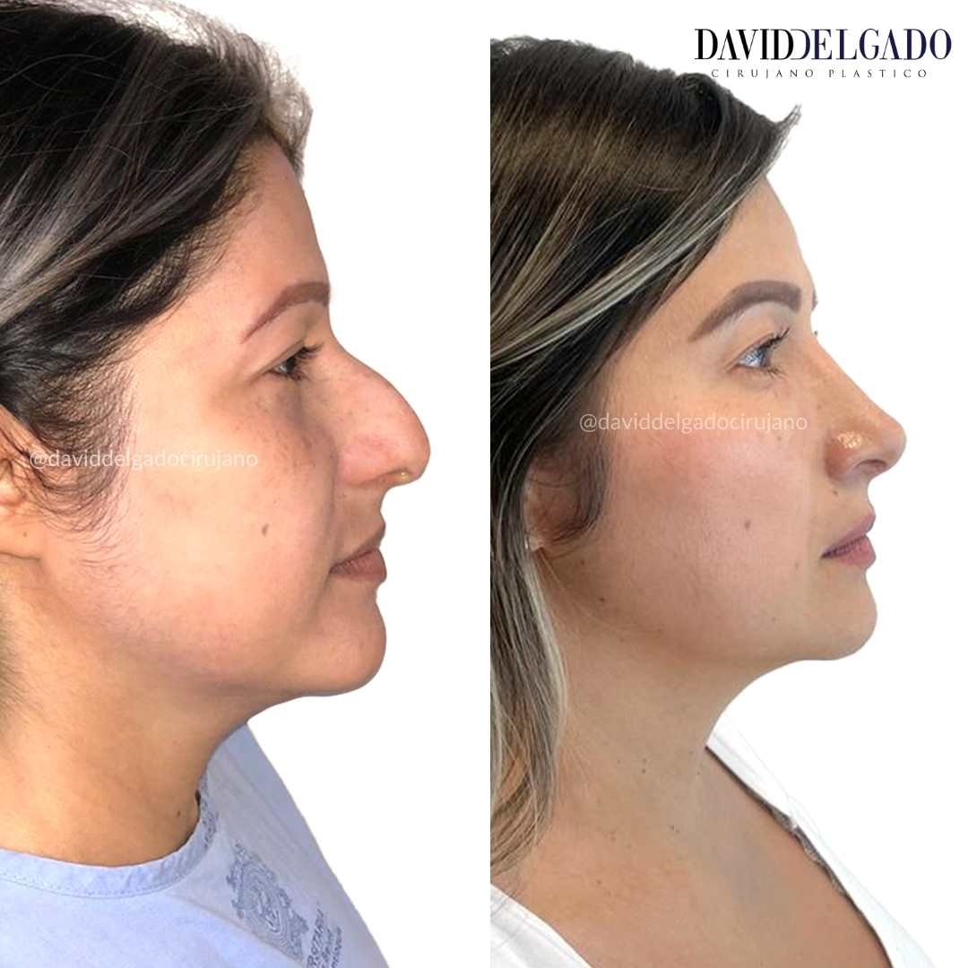 Before and after pics of a nose job in Colombia