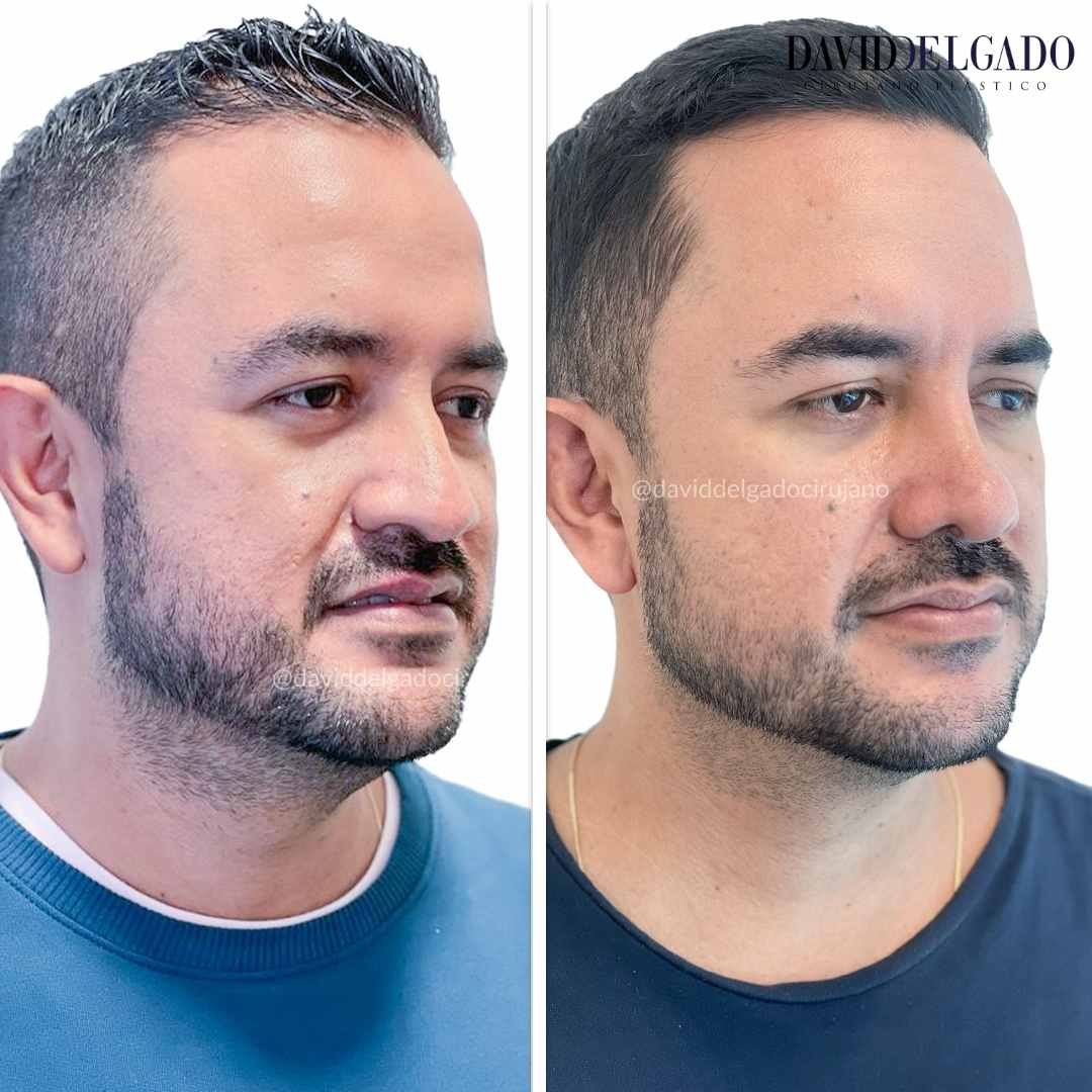 Rhinoplasty case study from Colombia: before and after