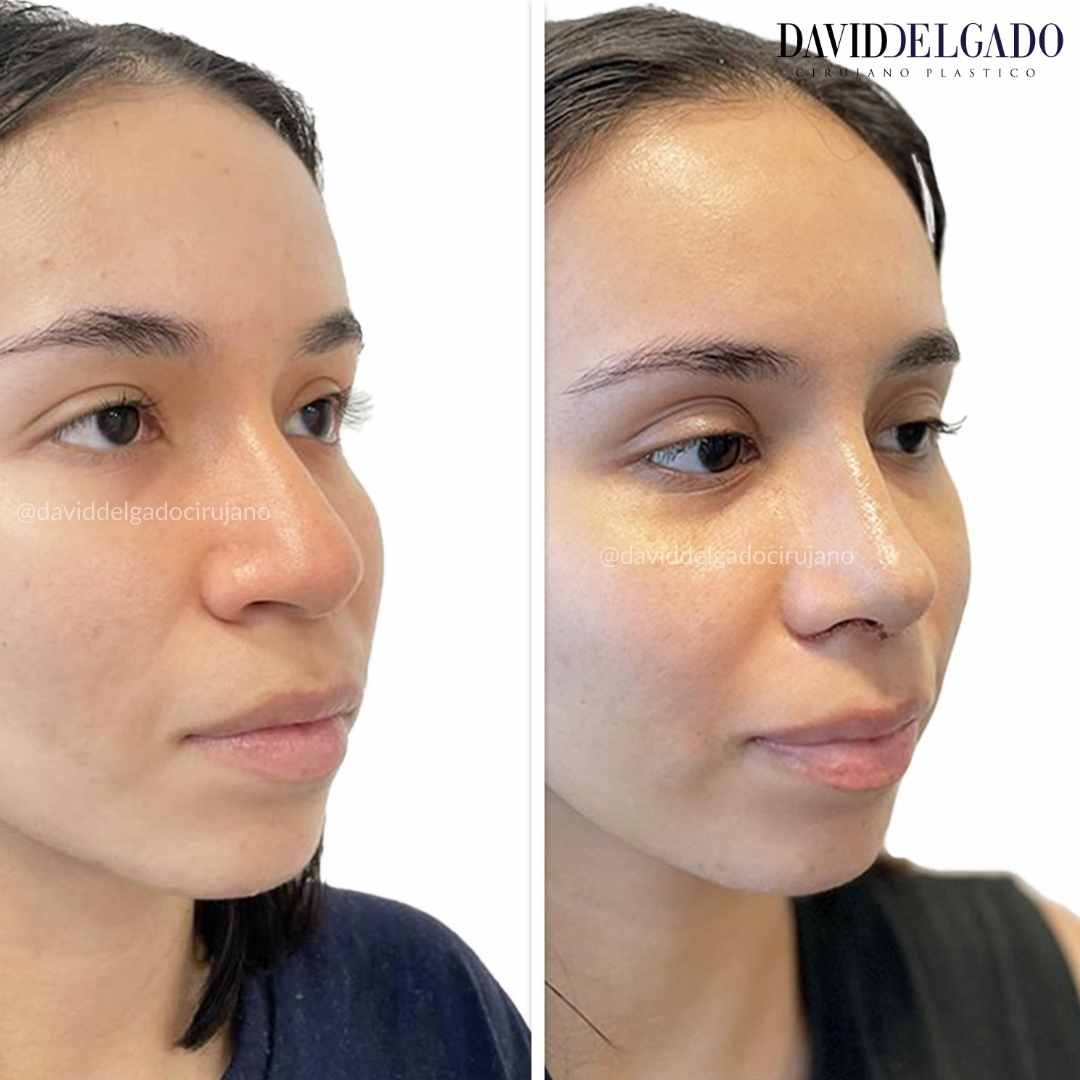 Rhinoplasty before and after pictures in Colombia