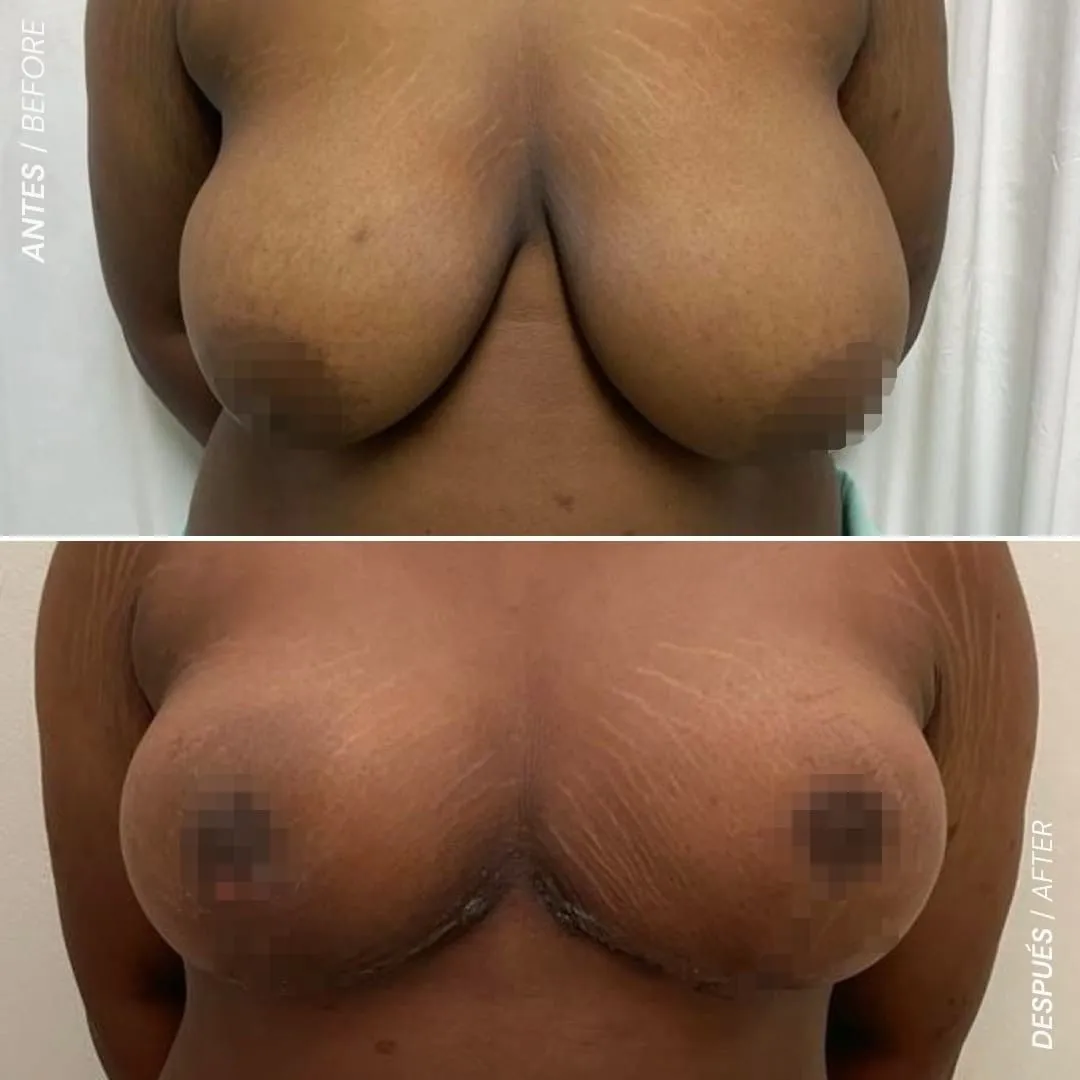 Mamoplasta de Reducción en Medellín