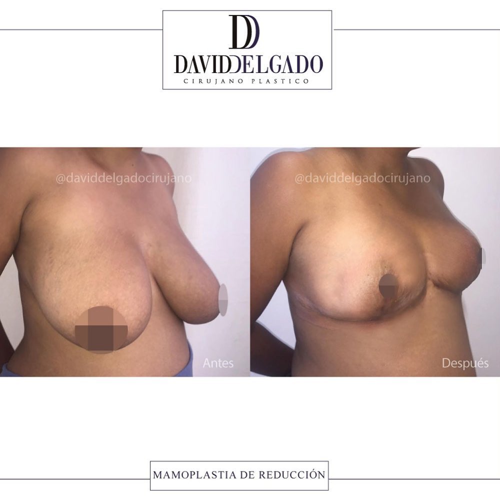 Breast Reduction Colombia