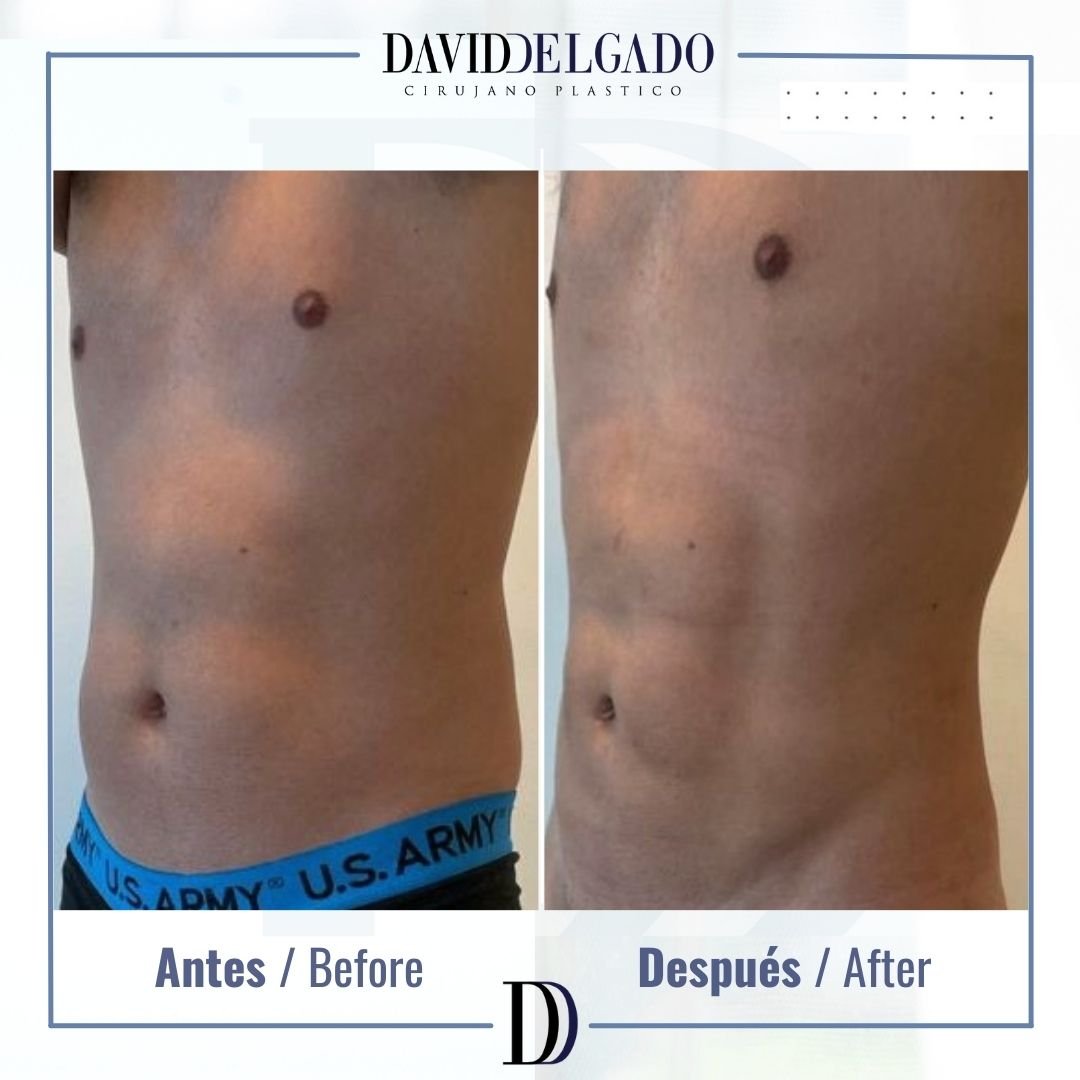 Marcación Abdominal Hombres en Medellín