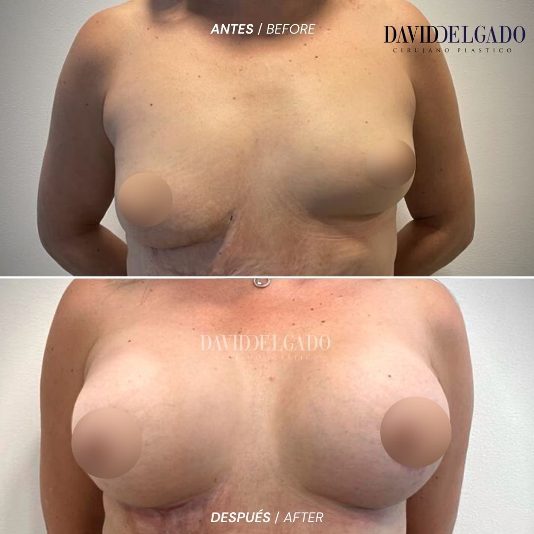 Mamoplastia de Aumento