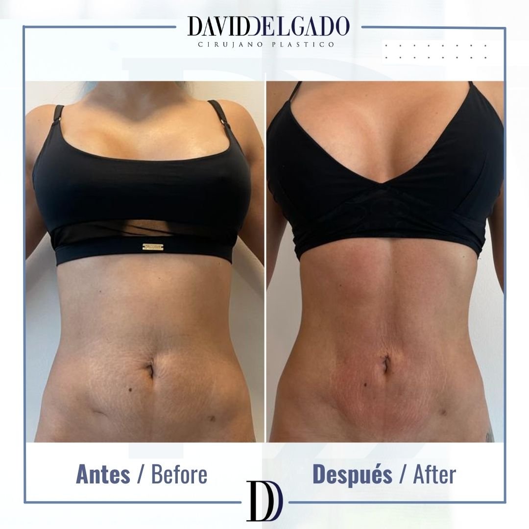 Before and After liposuction | David Delgado Plastic Surgery in Medellín