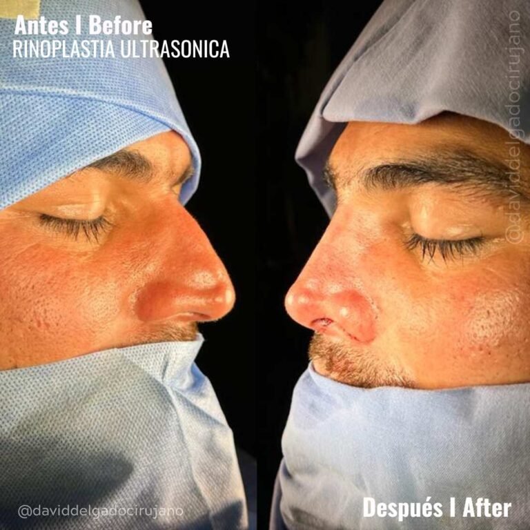 ANTES-Y-DESPUES-ULTRASONIC