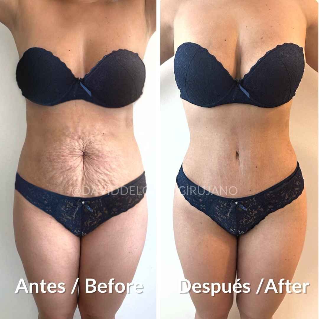 Before and After Abdominoplasty + Buttock Lipoinjection