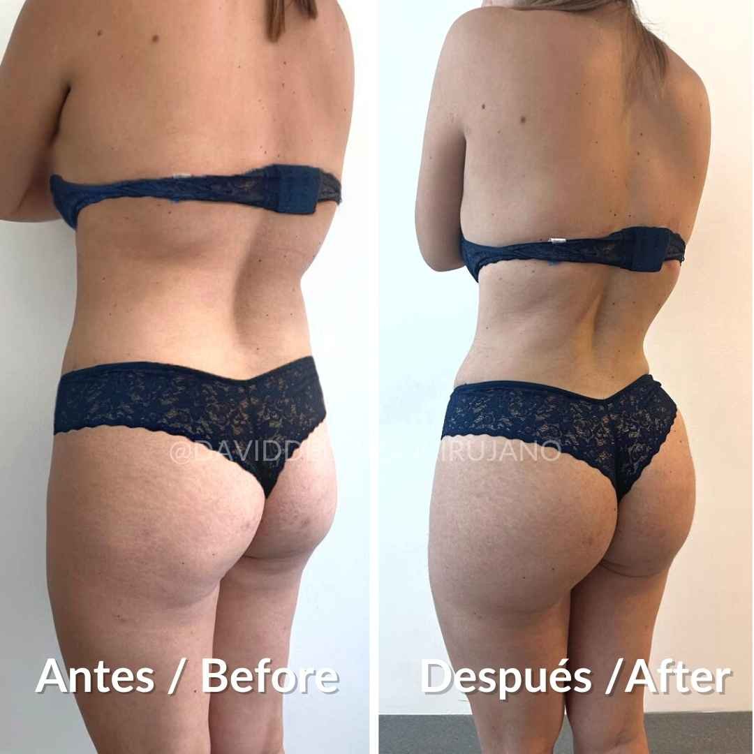 Before and After Abdominoplasty + Buttock Lipoinjection