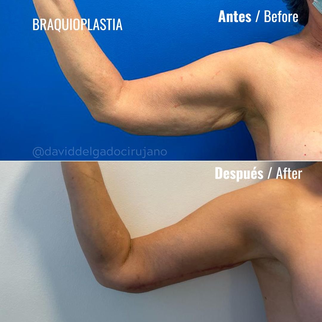 Before and After Brachioplasty | David Delgado Plastic Surgery in Medellín