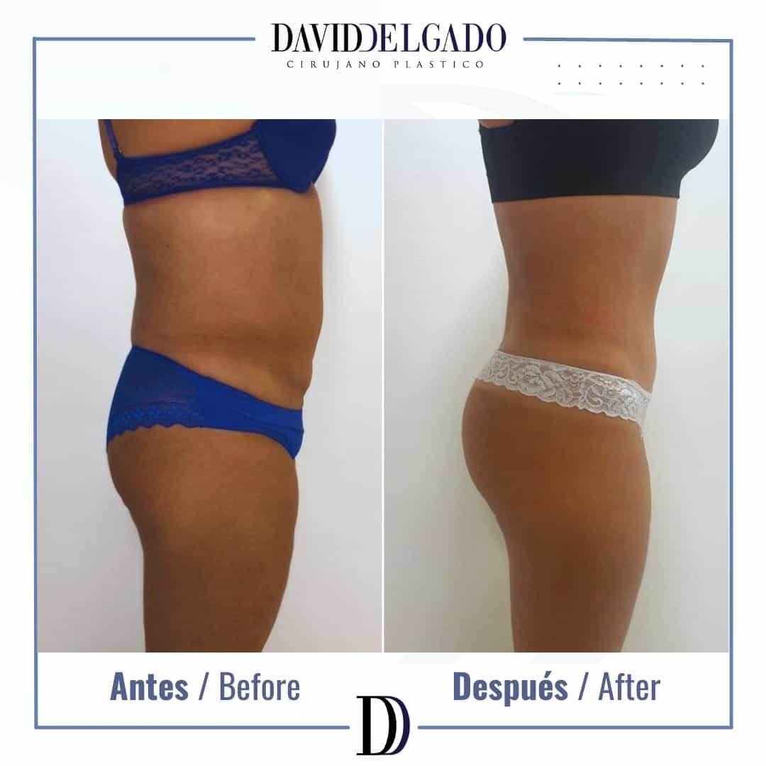 Before and After liposuction | David Delgado Plastic Surgery in Medellín