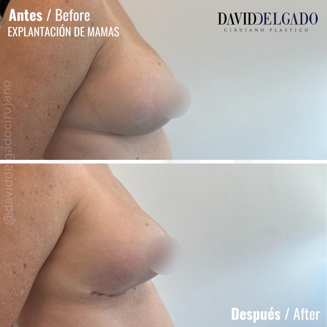 Before and After Breast Liposplasty | David Delgado Plastic Surgery in Medellín