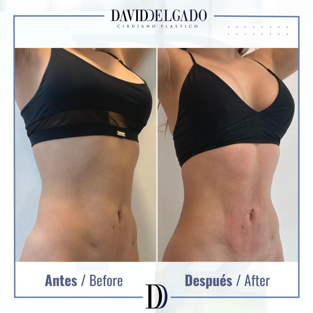 Before and After liposuction | David Delgado Plastic Surgery in Medellín