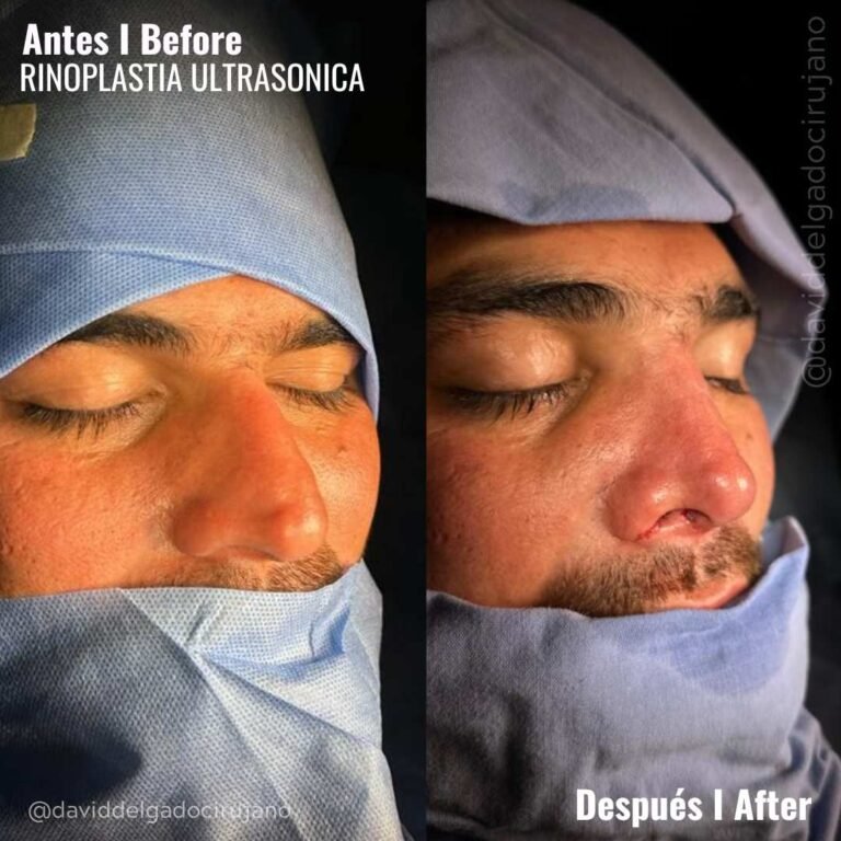 RINOPLASTIA-ULTRASONICA-ANTES-Y-DESPUES