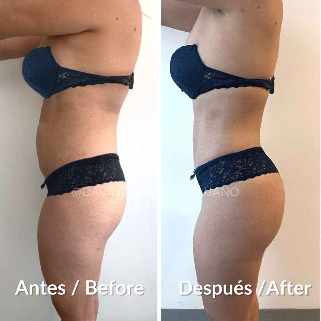 Tummy tuck before and after case 2 — Dr. David Delgado, Colombia