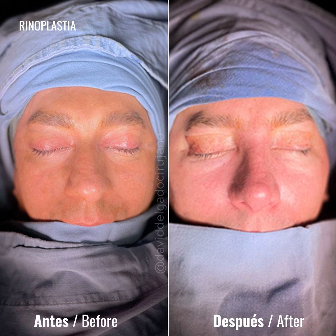 Before and After Rhinoplasty | David Delgado Plastic Surgery in Medellín