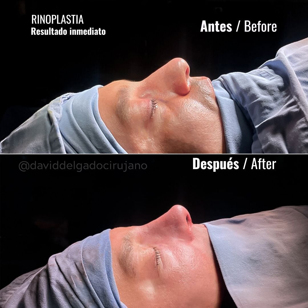 Before and After Rhinoplasty | David Delgado Plastic Surgery in Medellín