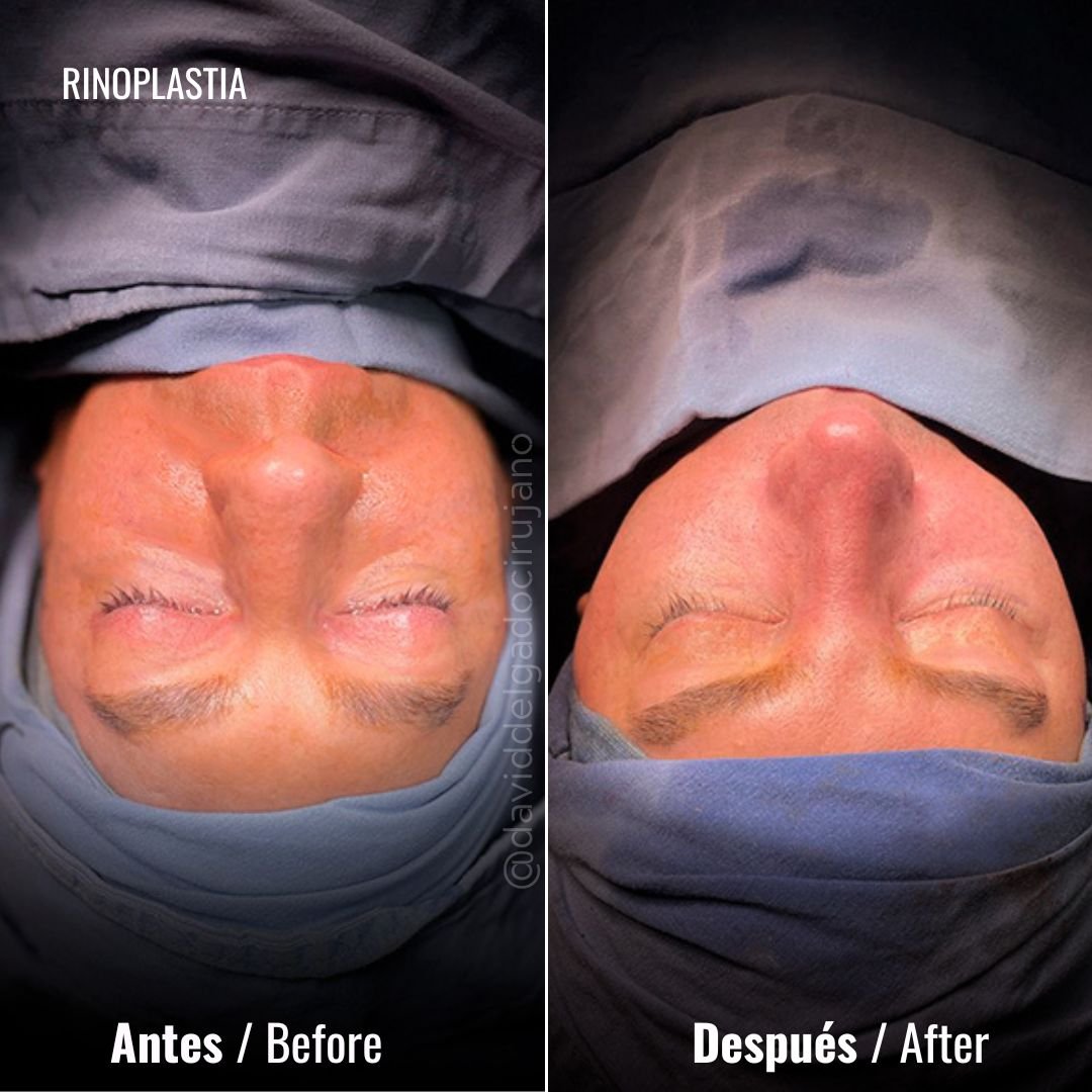 Before and After Rhinoplasty | David Delgado Plastic Surgery in Medellín