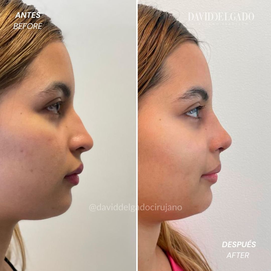 Before and After Rhinoplasty | David Delgado Plastic Surgery in Medellín