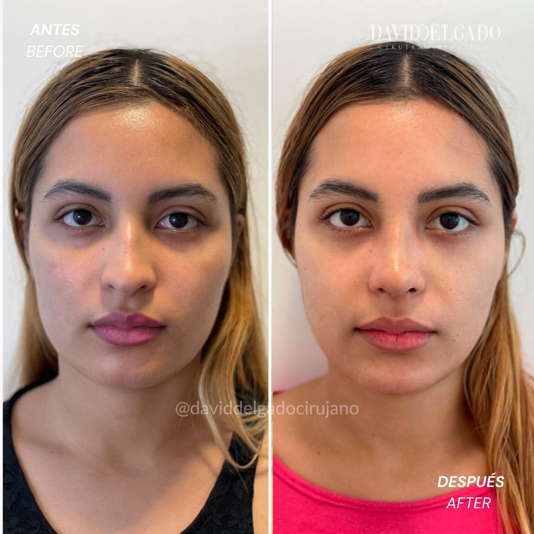 Before and After Rhinoplasty | David Delgado Plastic Surgery in Medellín