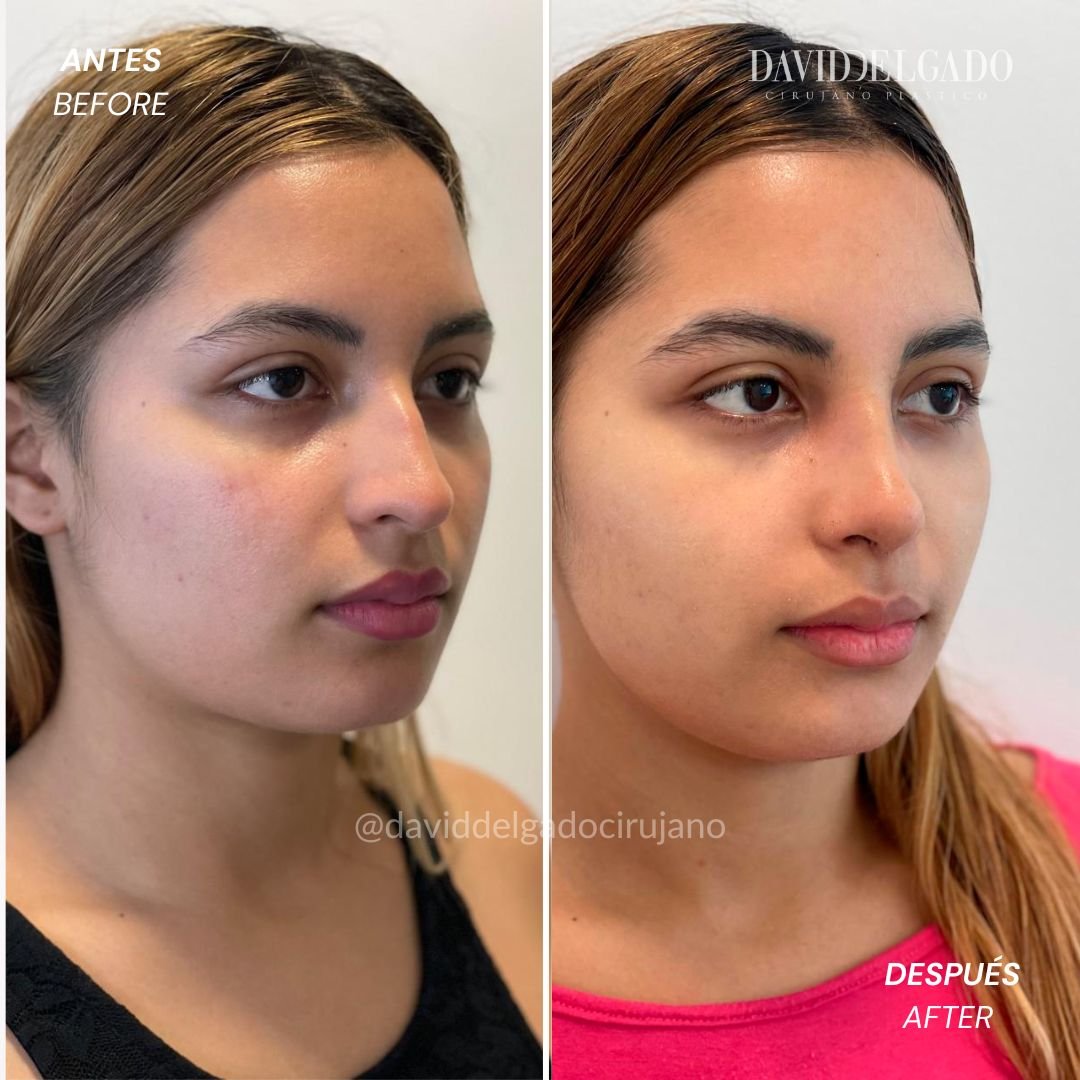 Before and After Rhinoplasty | David Delgado Plastic Surgery in Medellín