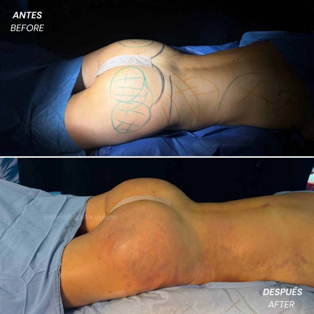 Before and After Gluteoplasty | David Delgado Plastic Surgery in Medellín