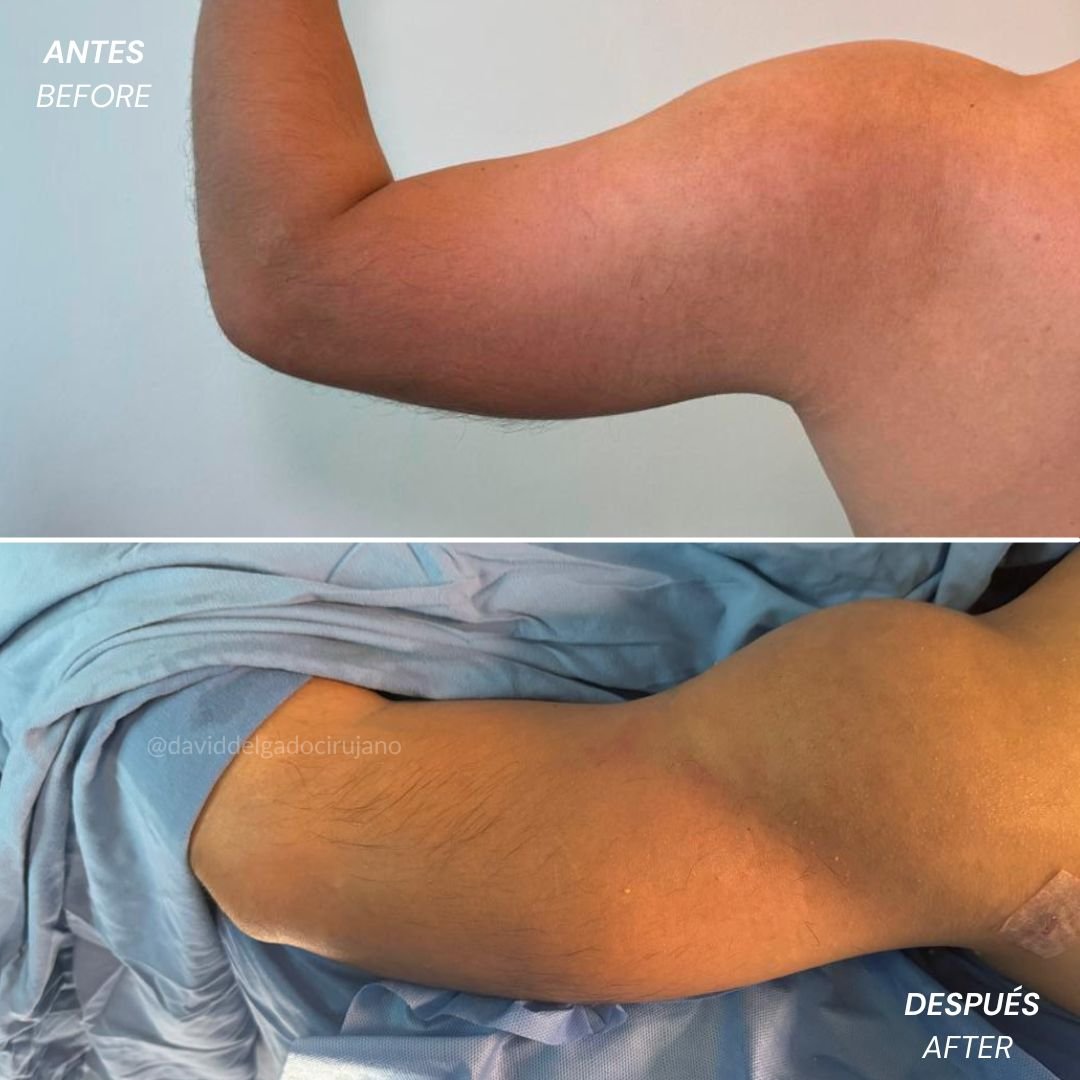 Before and After Brachioplasty | David Delgado Plastic Surgery in Medellín