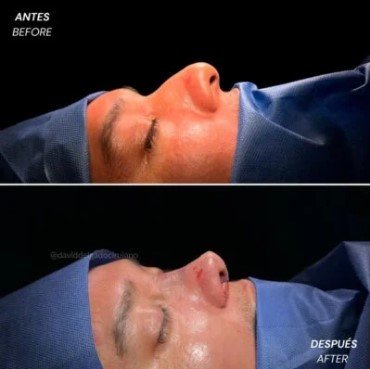 Rhinoplasty scar