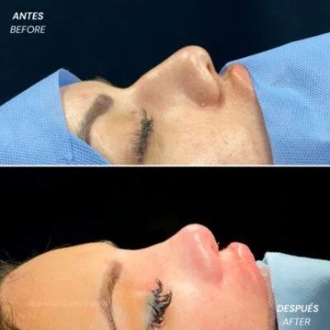Rhinoplasty scar