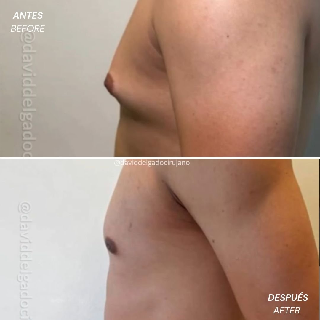 Before and after gynecomastia correction | Dr. David Delgado