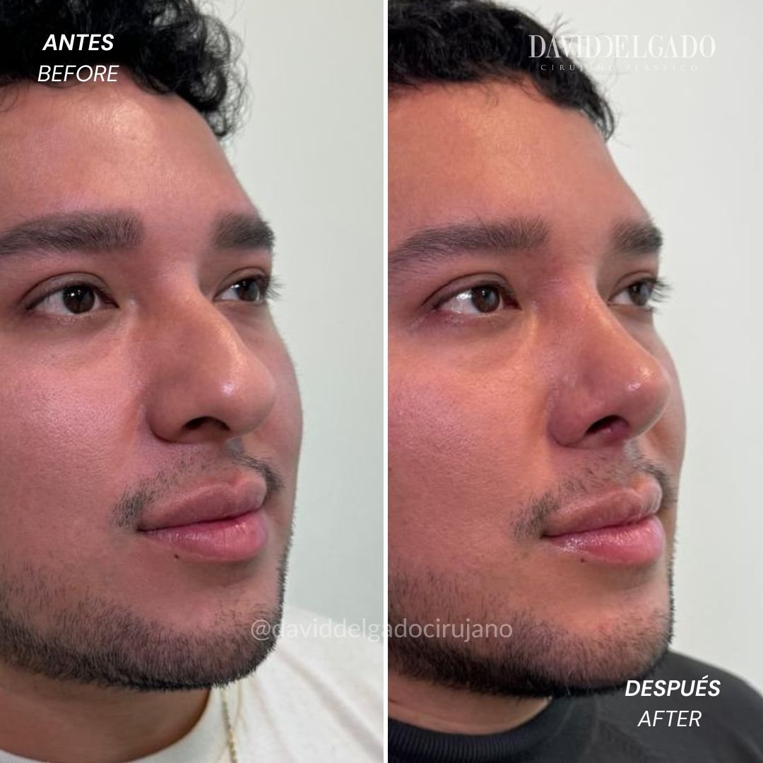 Before and After Rhinoplasty David Delgado Plastic Surgery in Medellín
