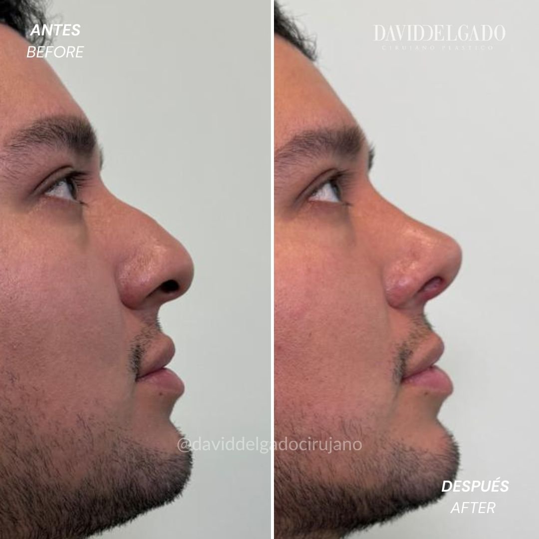 Before and After Rhinoplasty David Delgado Plastic Surgery in Medellín