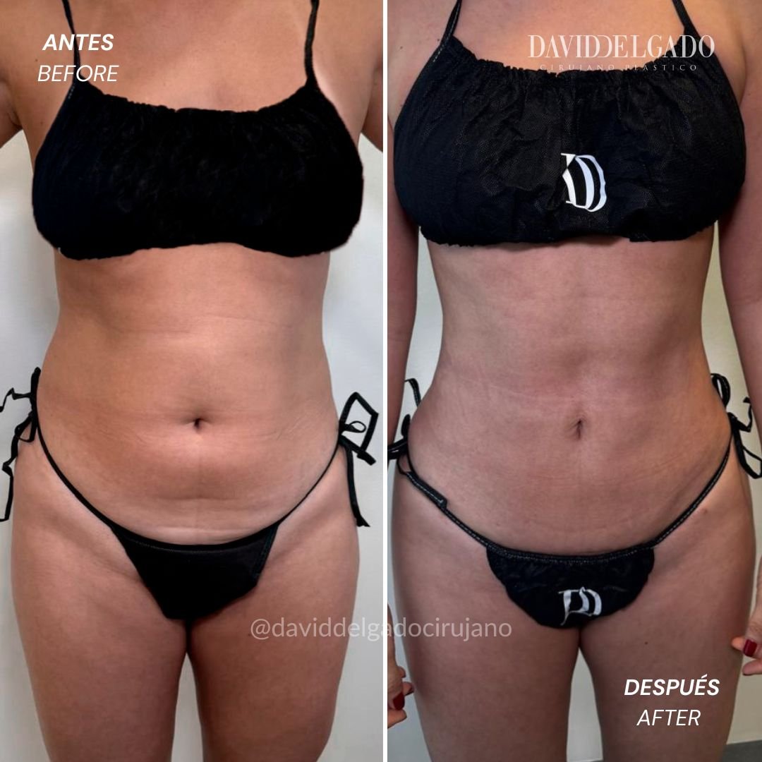 Before and After liposuction David Delgado Plastic Surgery in Medellín