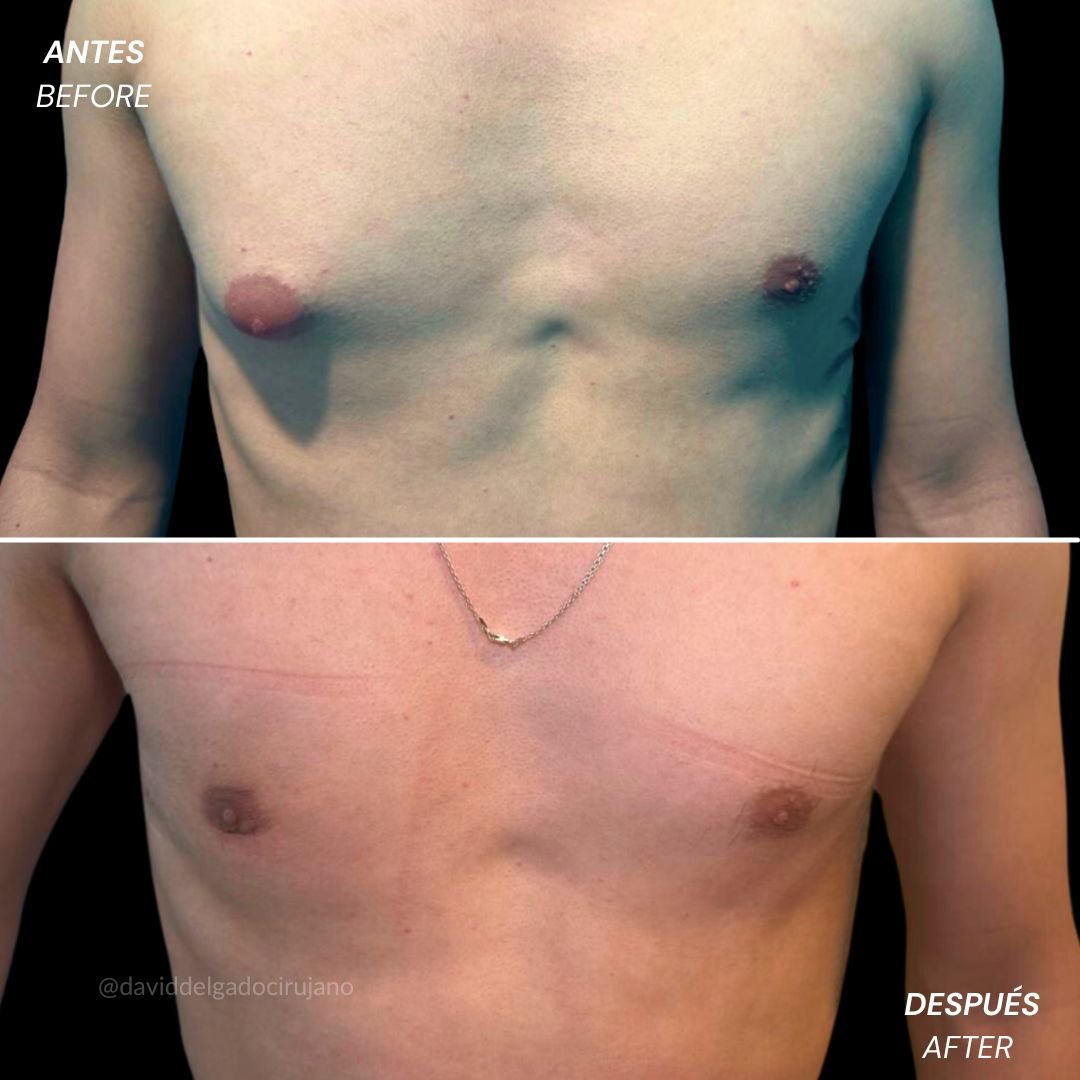 Before and after gynecomastia correction | Dr. David Delgado