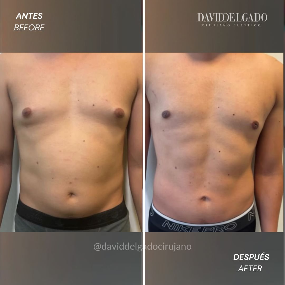 Before and after Abdominal marking and correction of gynecomastia - Dr. David delgado Plastic Surgery in Medellín