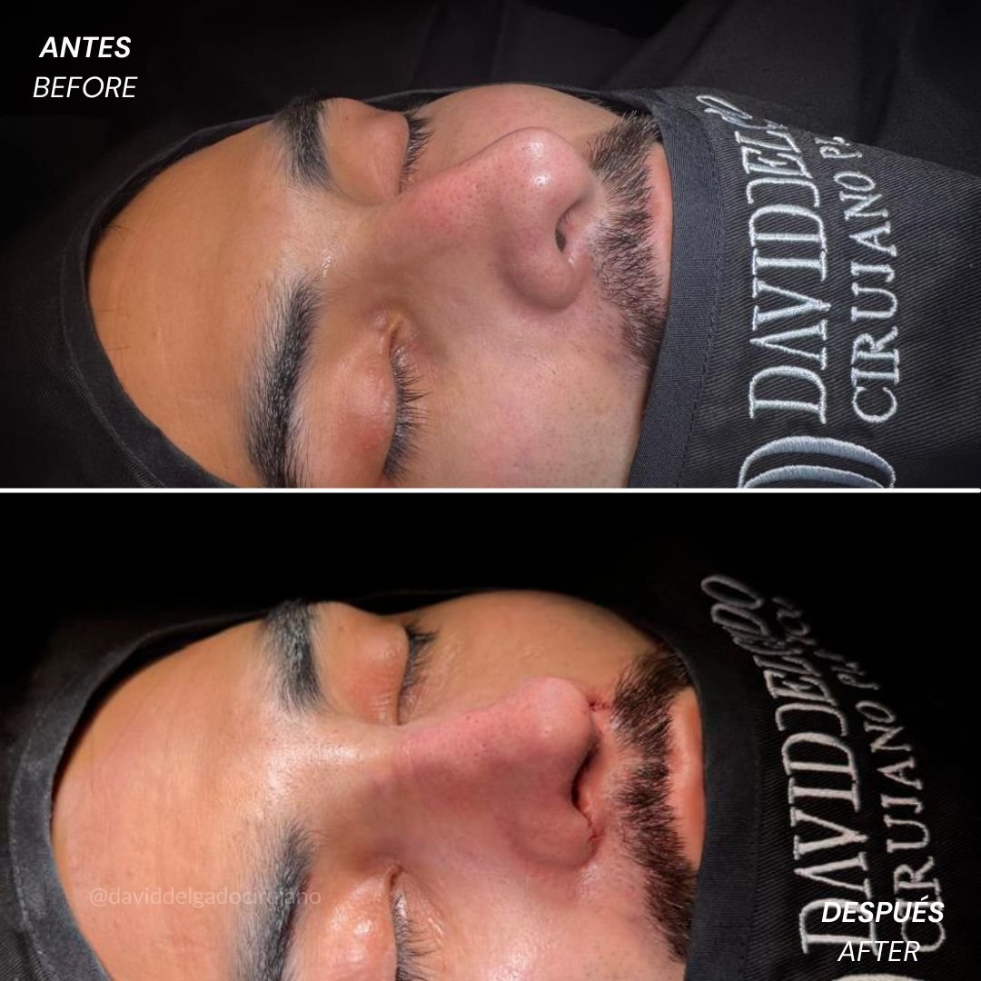 Before and After Rhinoplasty David Delgado Plastic Surgery in Medellín