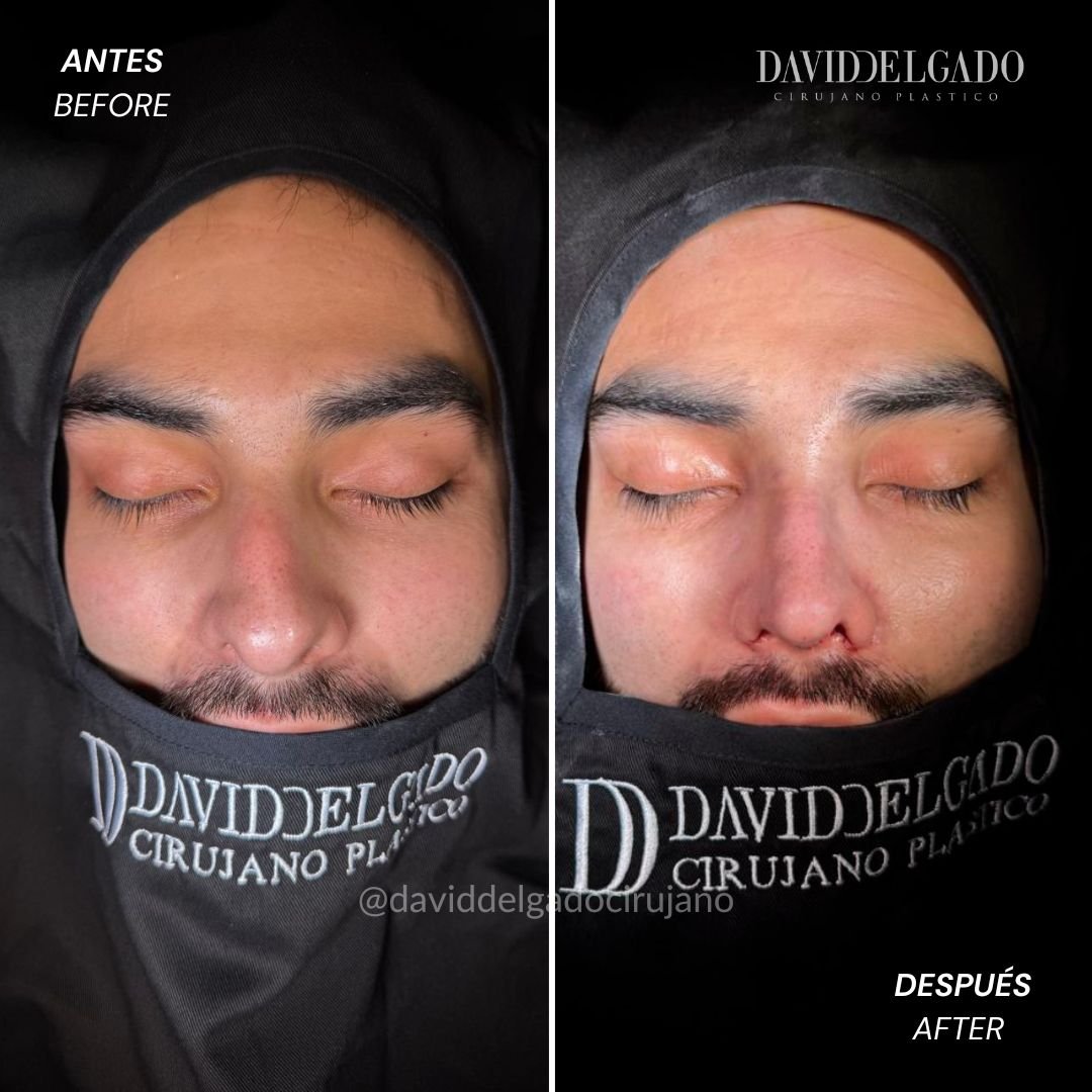 Before and After Rhinoplasty David Delgado Plastic Surgery in Medellín