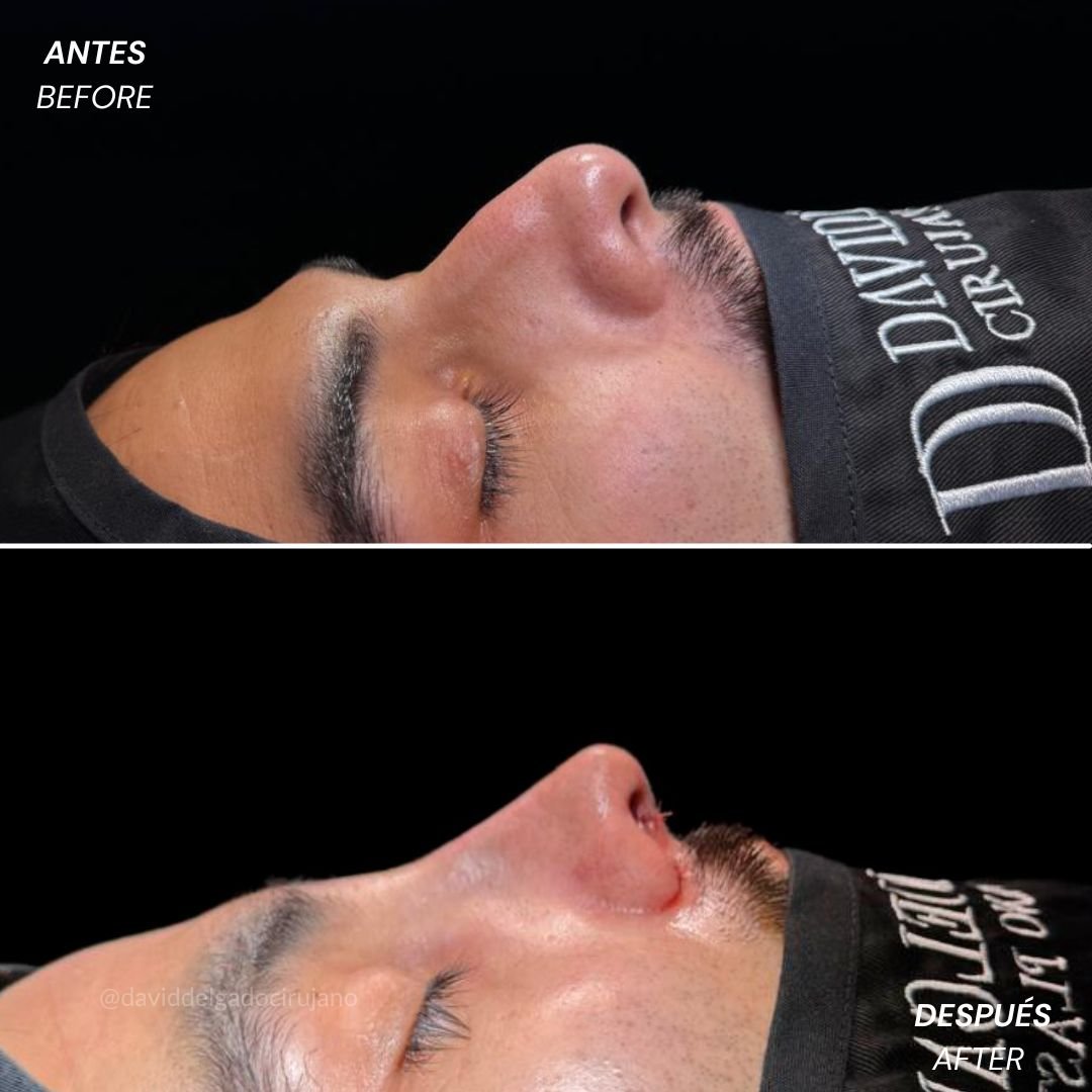 Before and After Rhinoplasty David Delgado Plastic Surgery in Medellín