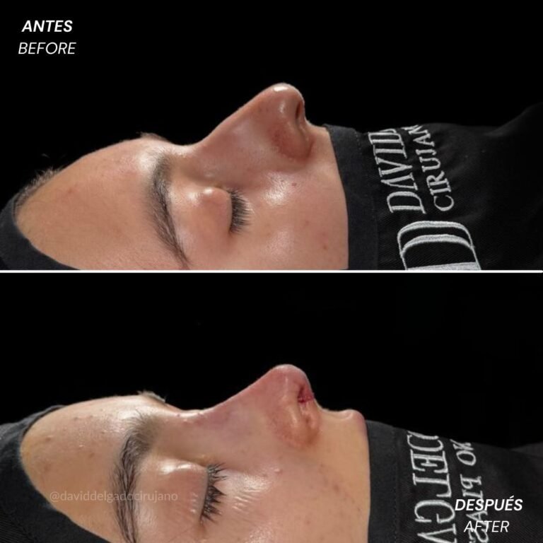 Before and After Ultrasonic Rhinoplasty David Delgado Plastic Surgery in Medellín