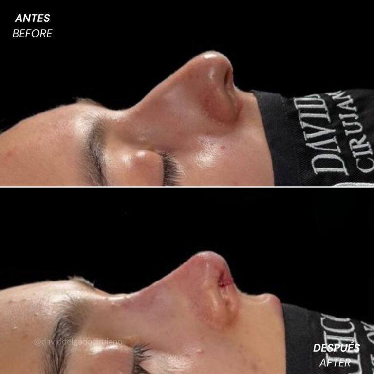 Before and After Ultrasonic Rhinoplasty David Delgado Plastic Surgery in Medellín