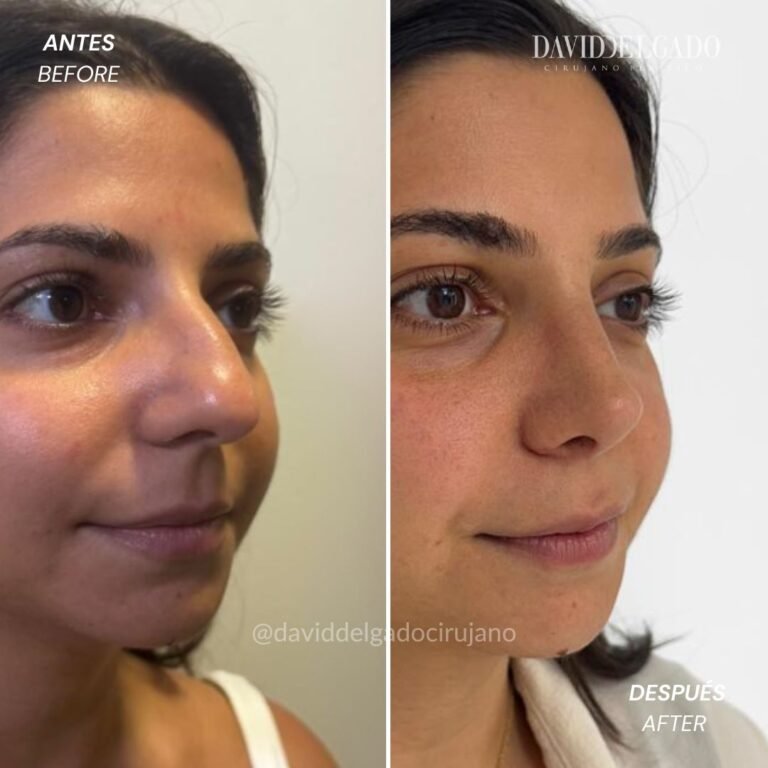 Before and After Ultrasonic Rhinoplasty David Delgado Plastic Surgery in Medellín