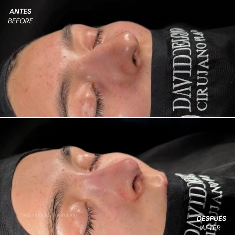 Before and After Ultrasonic Rhinoplasty David Delgado Plastic Surgery in Medellín