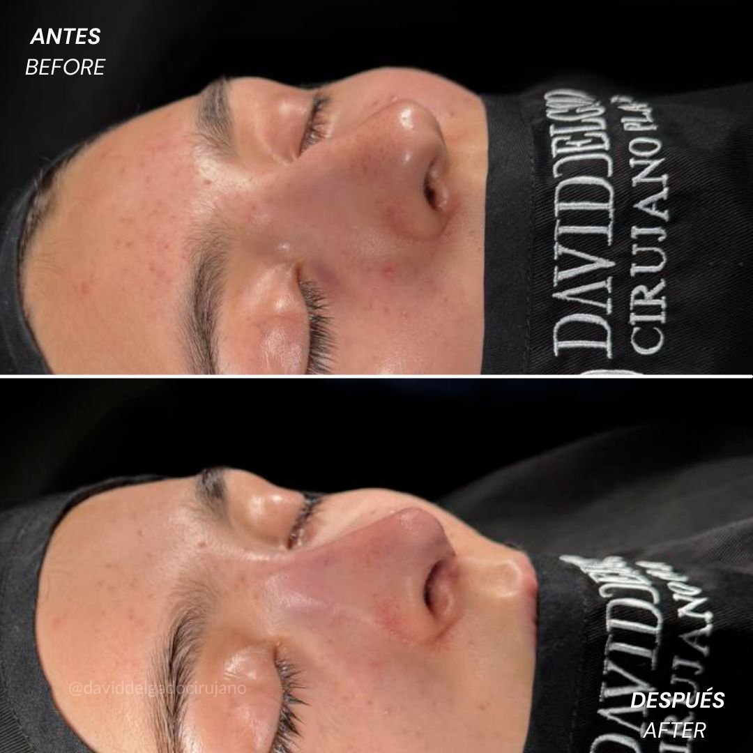 Before and After Ultrasonic Rhinoplasty David Delgado Plastic Surgery in Medellín