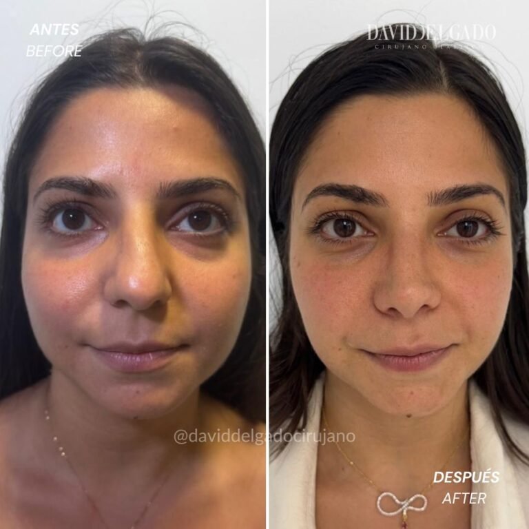 Before and After Ultrasonic Rhinoplasty David Delgado Plastic Surgery in Medellín