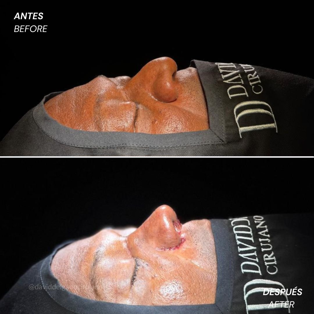 Before and After Rhinoplasty David Delgado Plastic Surgery in Medellín