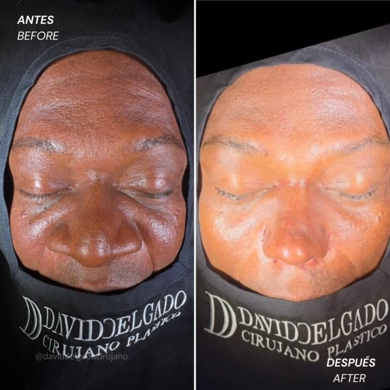 Before and After Rhinoplasty David Delgado Plastic Surgery in Medellín