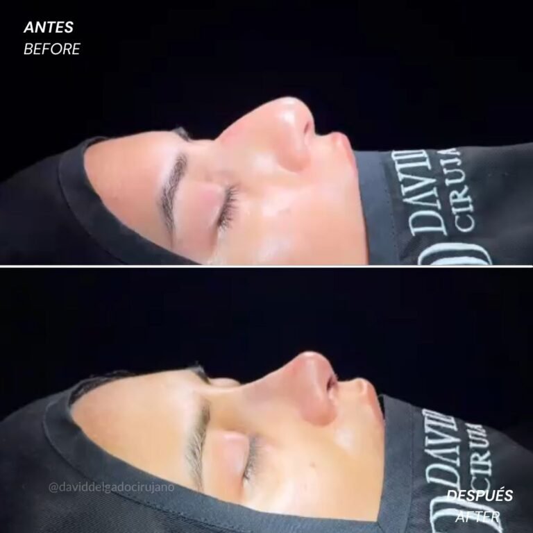 Before and After Ultrasonic Rhinoplasty David Delgado Plastic Surgery in Medellín