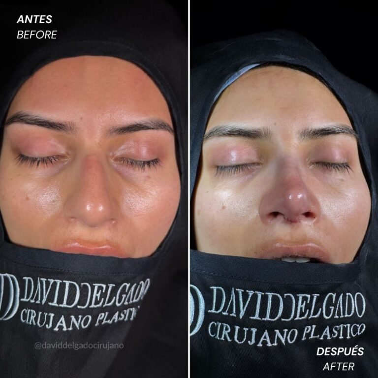 Before and After Ultrasonic Rhinoplasty David Delgado Plastic Surgery in Medellín