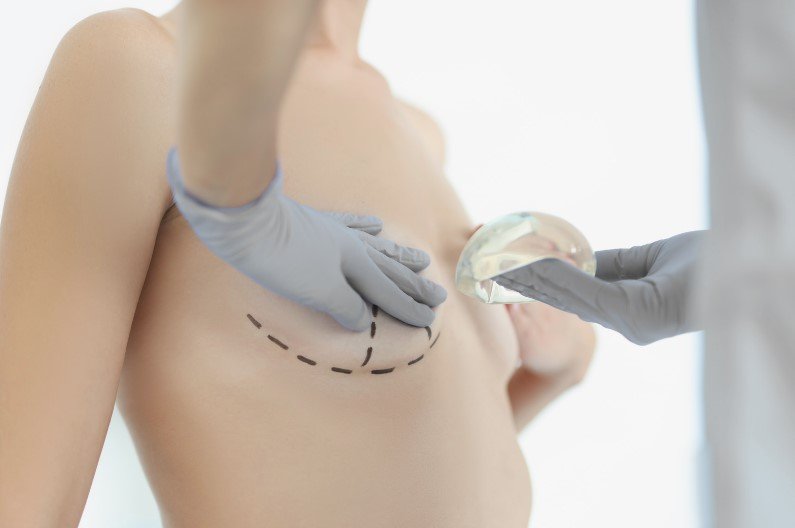Inframammary scar in an inverted T or anchor shape - - Dr. David Delgado - Colombian Boob Job