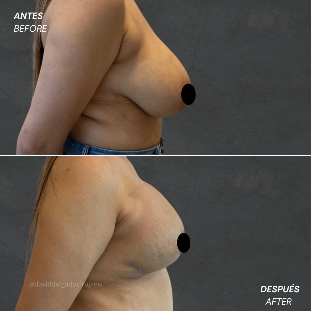 Before and After Mastopexy David Delgado Plastic Surgery in Medellín