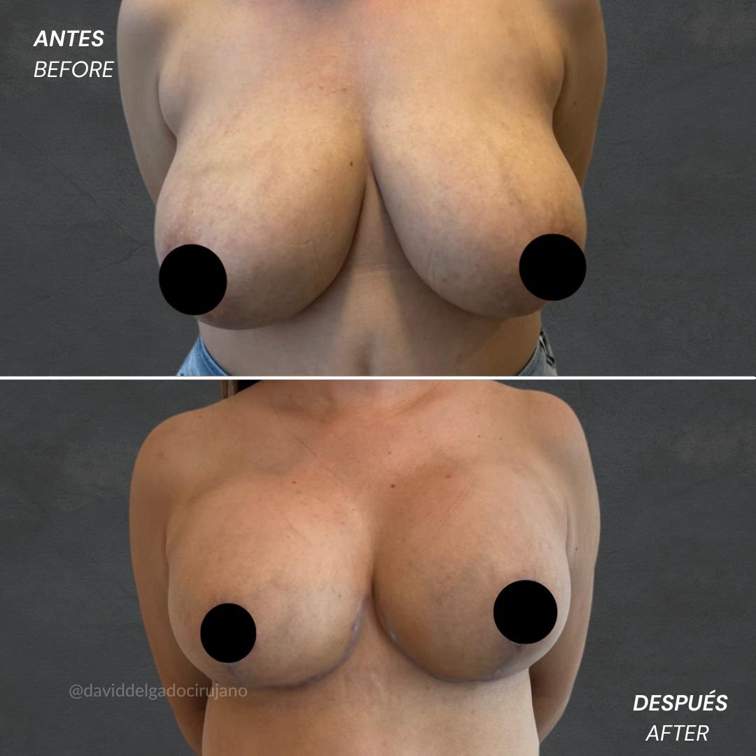 Before and After Mastopexy David Delgado Plastic Surgery in Medellín